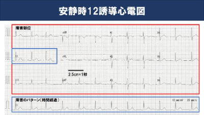 安静時12誘導心電図