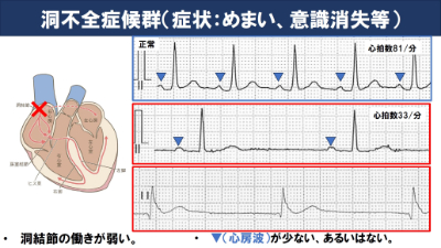 洞不全症候群（症状：めまい、意識消失等）