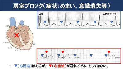 房室ブロック（症状：めまい、意識消失等）