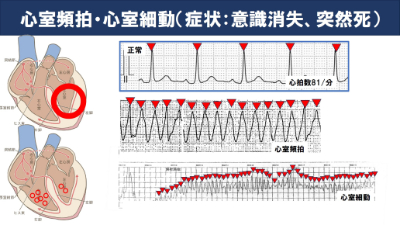 心室頻拍・心室細動（症状：意識消失、突然死）