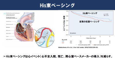 His束ペーシング