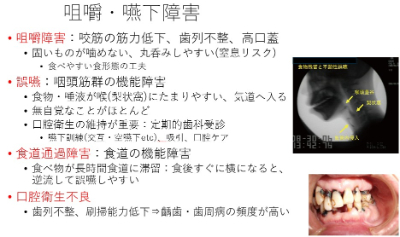 咀嚼・嚥下障害